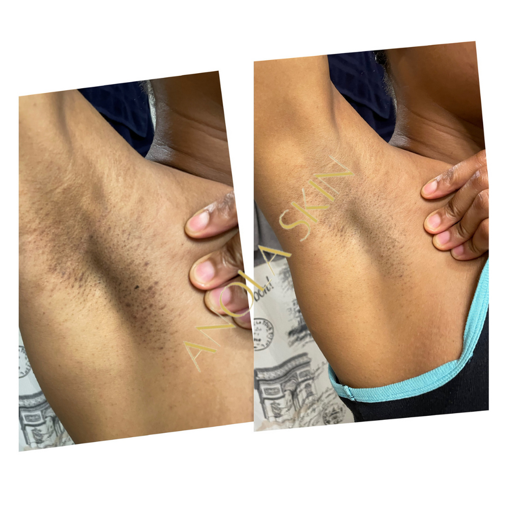 Intense Discoloration Treatment